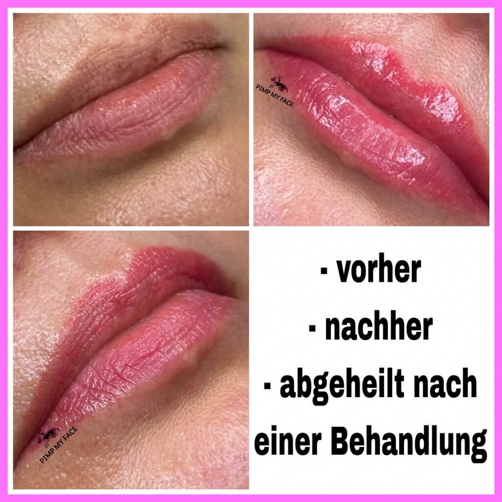 Lippen-Permanent-MakeUp- abgeheilt-Hamburg-vorher-nachher